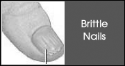 Brittle Nails