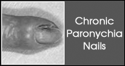 Chronic Paronychia Nails