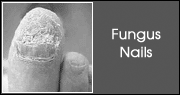 Fungus Nails