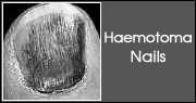 Haematoma Nails