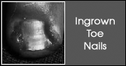 In growing toe nails