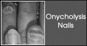 Onycholysis Nails