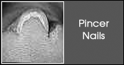 Pincer Nails