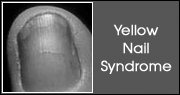 Yellow Nail Syndrome