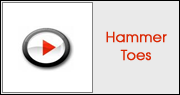Hammer Toes