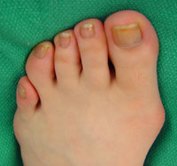 Bunions Callous