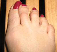 Bunions
