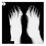 foot arthritis