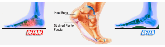 Calcaneal Spur