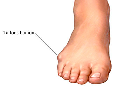 Bunions On Feet. A tailor#39;s union is very