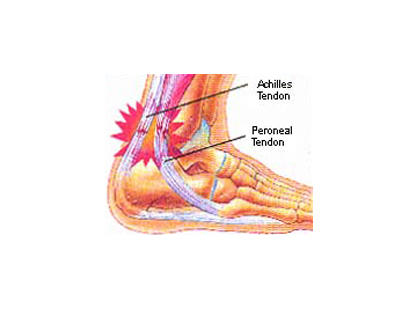 Achilles Heel Pain | Achilles Tendonitis - Dr Foot