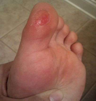 Foot Blisters 90